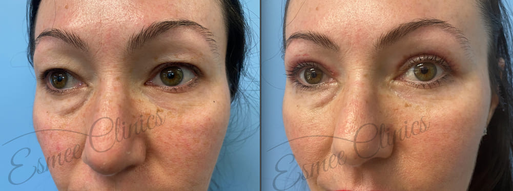 Before and After img